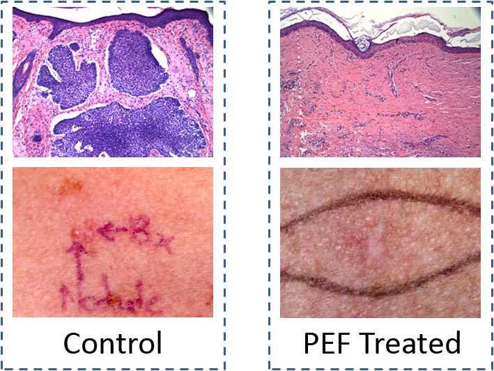 Cancer treatment